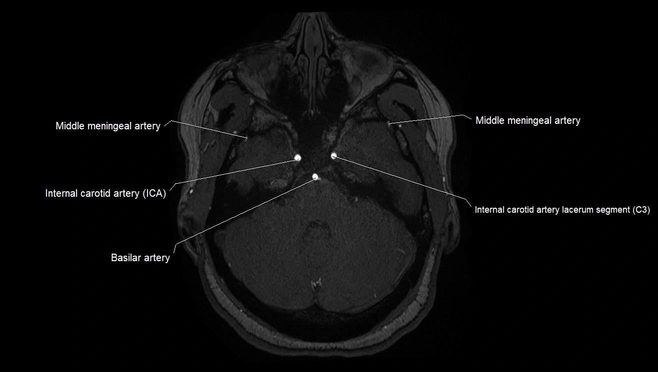 MRA brain (cerebral arteries) anatomy axial 3T image 5.webp